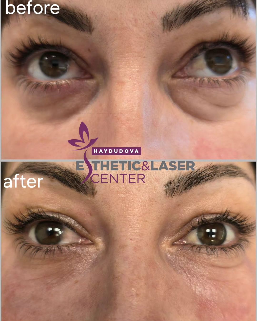 Случай на пациент Lenisna & JoveLook - haydudova Esthetic & Laser Center, гр. Плевен