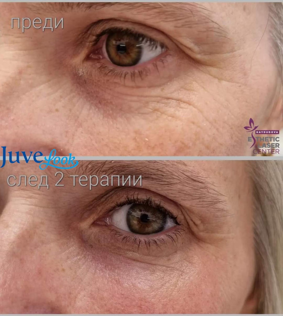 Случай на пациент Lenisna & JoveLook - haydudova Esthetic & Laser Center, гр. Плевен