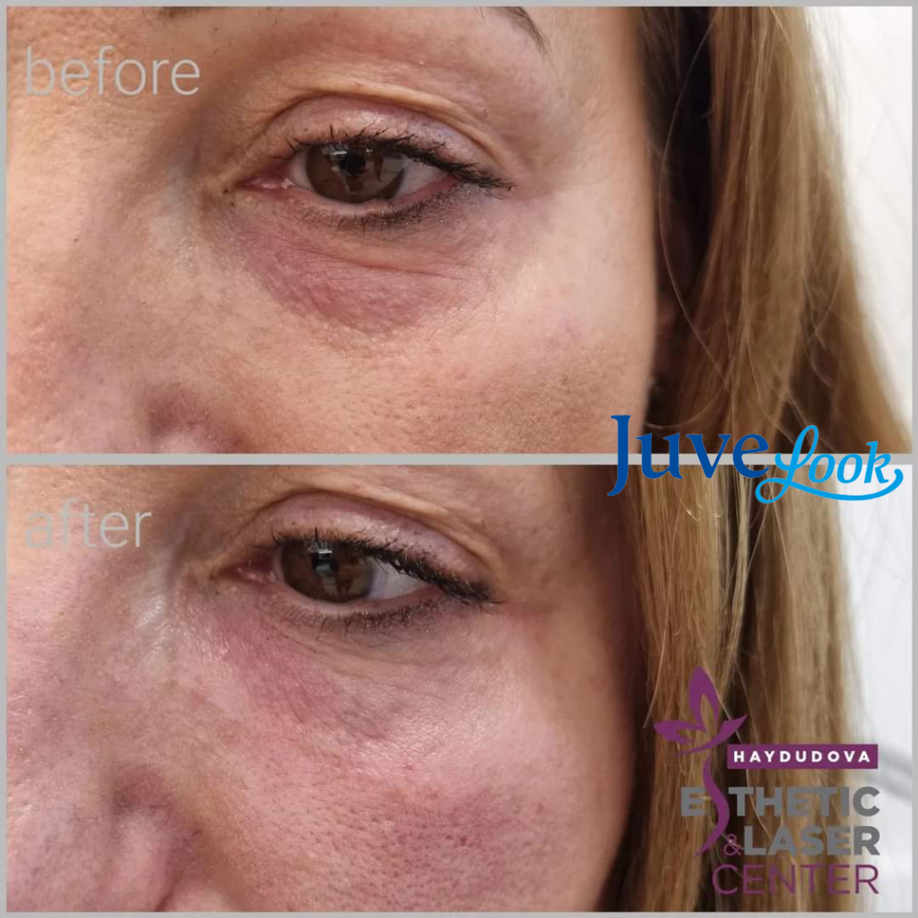 Случай на пациент Lenisna & JoveLook - haydudova Esthetic & Laser Center, гр. Плевен