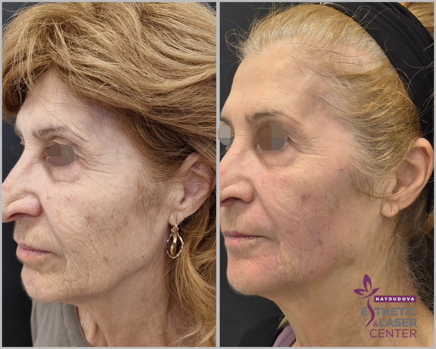 Случай на пациент Lenisna & JoveLook - haydudova Esthetic & Laser Center, гр. Плевен