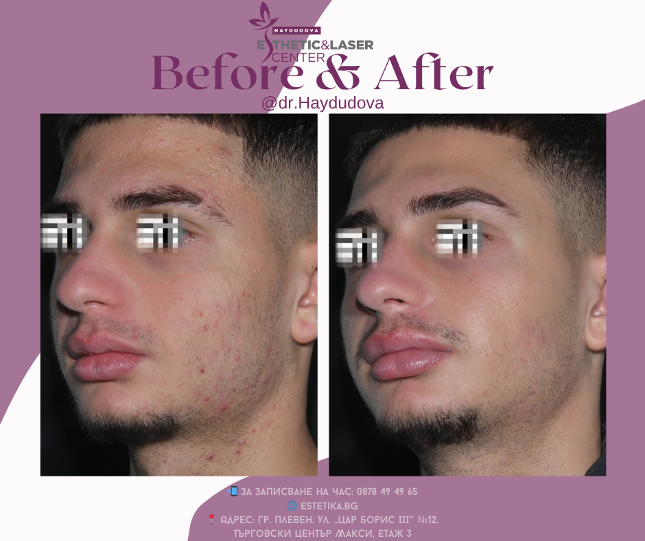 Преди ➡️ След | Лечение на акне и белези